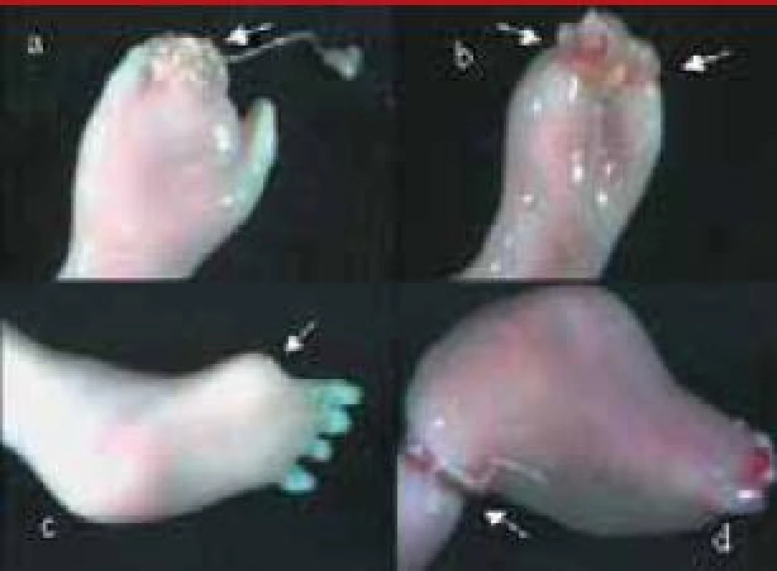 Syndróm amniových pruhov (8.–9. vývojový týždeň). Amputácia distálnych článkov prstov na rukách (a – pravej, b – ľavej), amputácia palca ľavej nohy (c) a strangulácia chodidla pravej nohy(d).