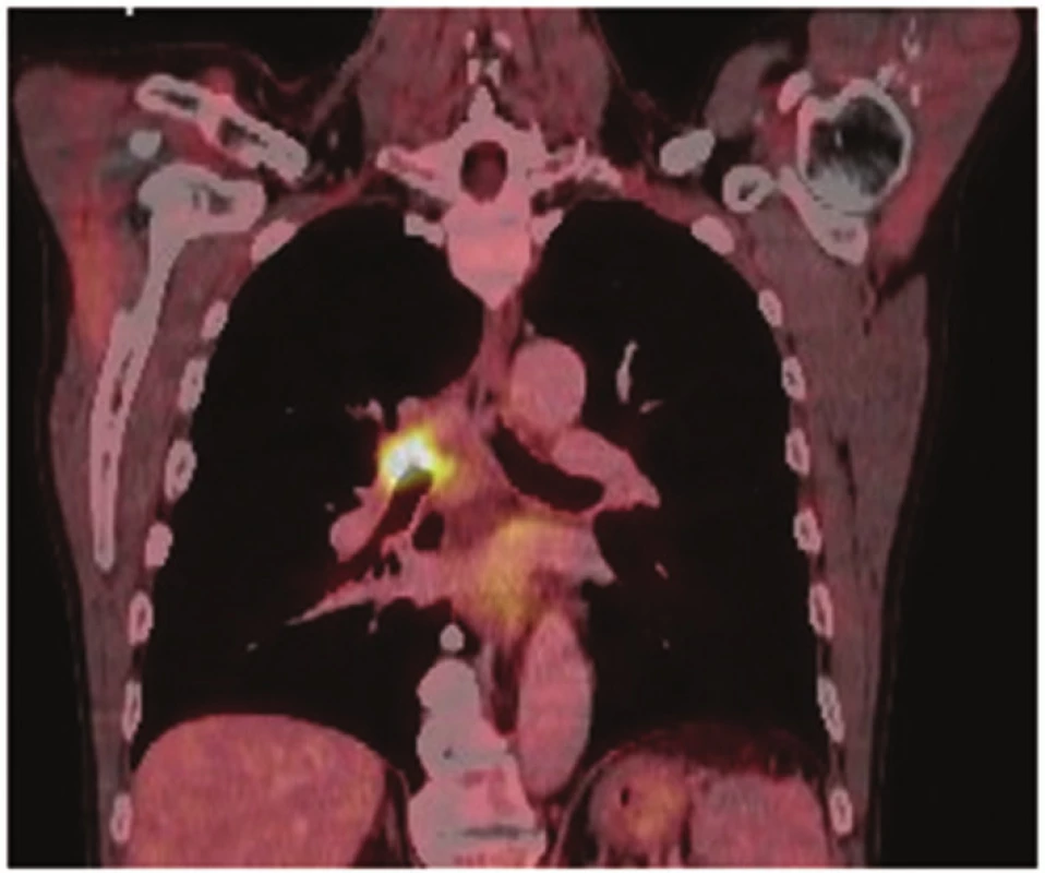 PET/CT: nádorové postižení kariny
Fig. 2: PET/CT: tumor of the carina