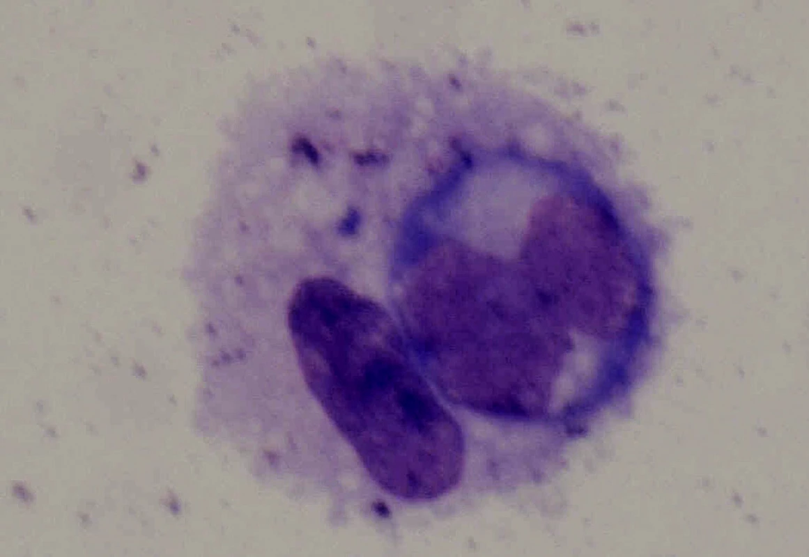 Atypický lymfocyt zachycený ze sklivce 68leté pacientky s non-Hodgkinským lymfomem CNS a oka