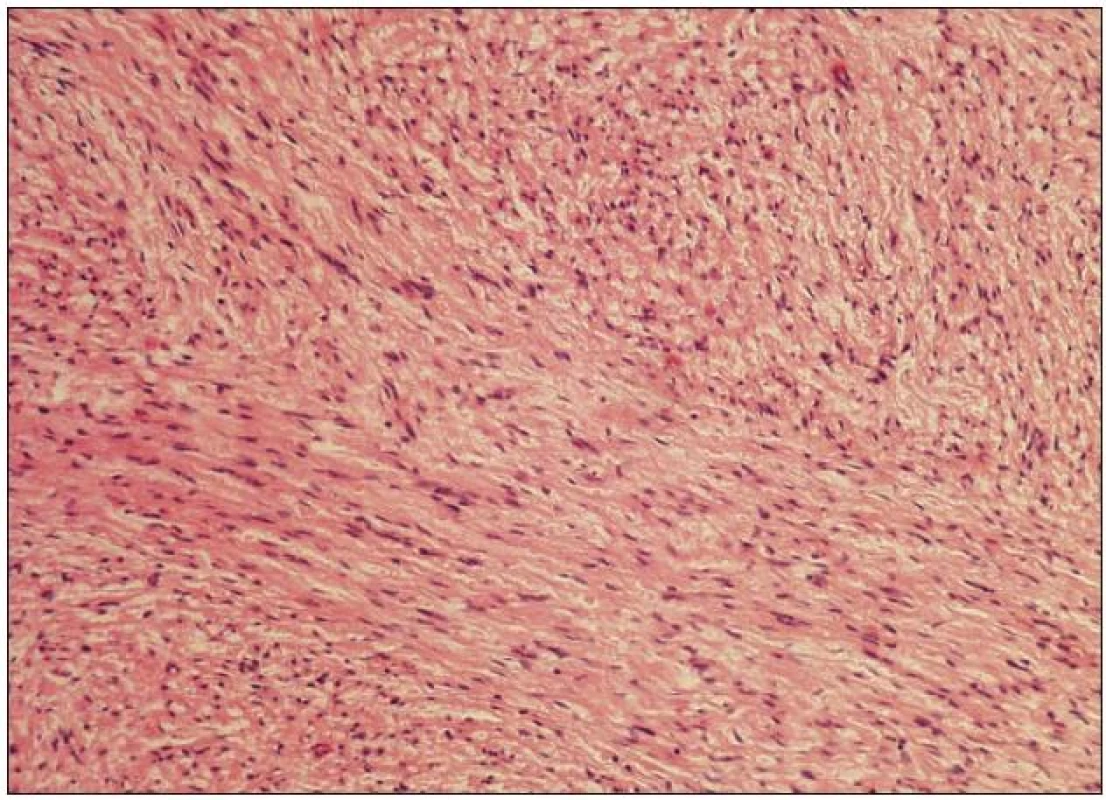 Histologický nález odpovídající neurofibromu s rysy schwannomu a perineurinomu – vřetenobuněčný, fascikulárně uspořádáný nádor s protáhlými jádry v barvení hematoxylin-eozin, zvětšeno 100×.