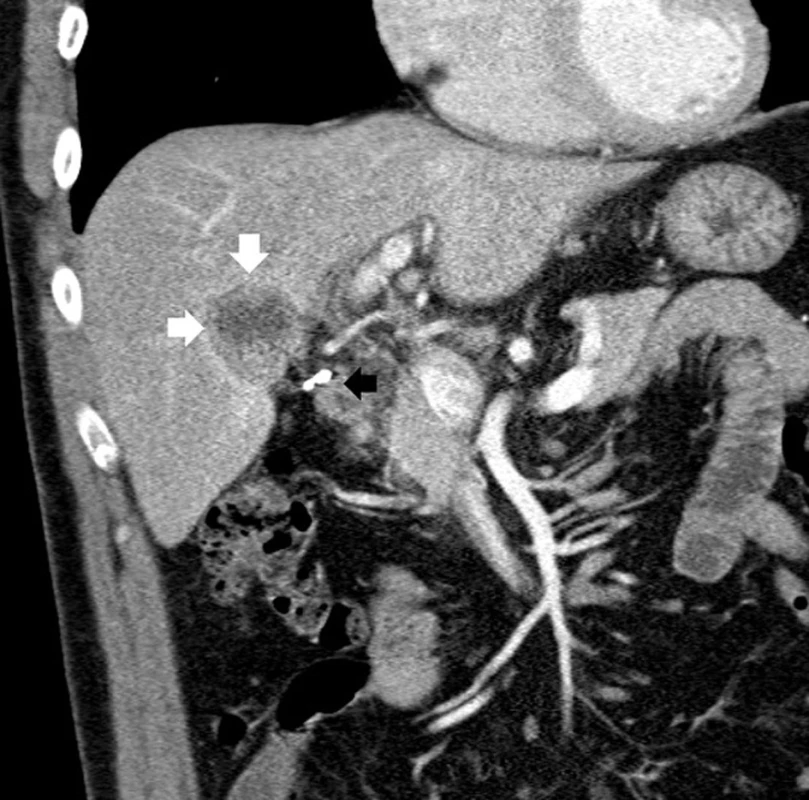 CT obraz intraparenchymatózně uloženého zdvojeného žlučníku (koronární řez) (Bílé šipky ukazují tumorózní útvar v hilu žlučníku, černá šipka svorky po předchozí laparoskopické cholecystektomii.)
Fig. 2: CT image of intraparenchymal double gallbladder (coronal section) (The white arrows are pointing at a tumorous lesion of the gallbladder hilum, the black arrow pointing at clips from previous laparoscopic holecystectomy.) 