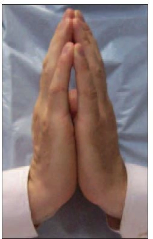 Znamení modlitby testující rozsah pohybu v drobných kloubech ruky – patologický nález.