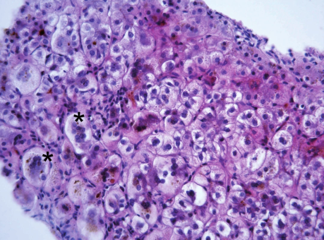 Obraz neonatální hepatitidy u 5měsíčního kojence s progresivní formou BSEP onemocnění s obrovskobuněčnou transformací hepatocytů (ozn. hvězdičkou)místy se zřetelnou převážně intracelulární cholestázou. V lalůčcích přítomny nespecifické zánětlivé změny v podobě histiocytárních uzlíků a lymfoplazmocelulárního infiltrátu.

Fig. 2. The picture of neonatal hepatitis in a 5-month infant with progressive form of BSEP disease with large cellular transformation of hepatocytes (marked with asterisk), occasionally with distinct mostly intracellular cholestasis. In the lobules are present nonspecific inflammatory changes in the form of histiocytic nodules and lymphoplasmocellular infiltrate.