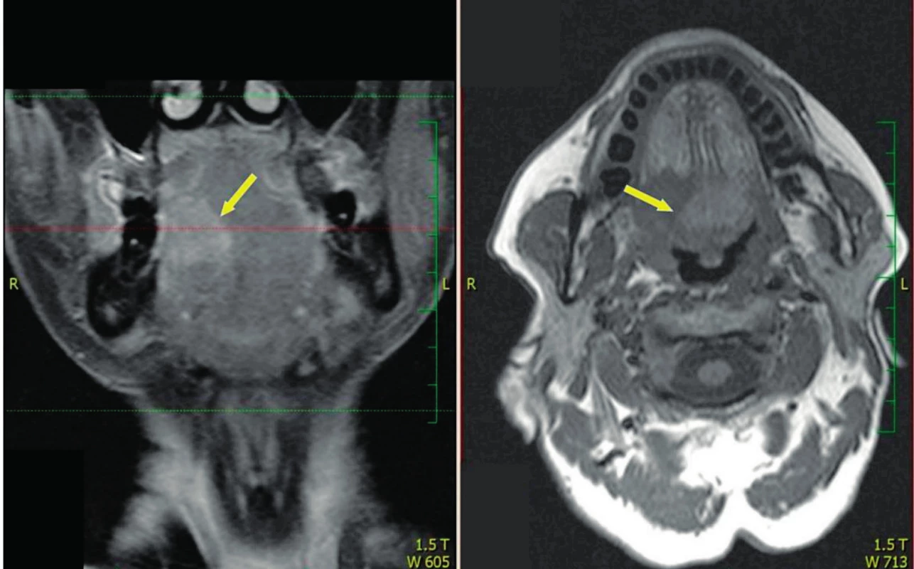Vlevo MR T2 s potlačením signálu, vpravo MR T1 - šipka ukazuje na oblast invaze nádoru kořene jazyka do ústní spodiny se šířením přes střední čáru.
