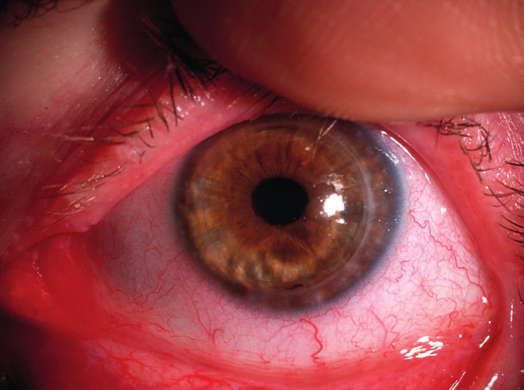 Stav zhruba 1 rok po provedení perforující keratoplastiky druhého oka též pacientky – již zhojeno, po extrakci stehů.