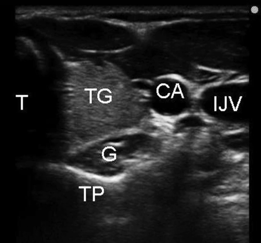 Ultrazvuková anatomie pro blokádu ganglion stellatum
Legenda: T – trachea, TG – štítná žláza, IJV – vena jugularis interna, CA – arteria carotis communis, TP – příčný výběžek C6, G – oblast krčního sympatického ganglia