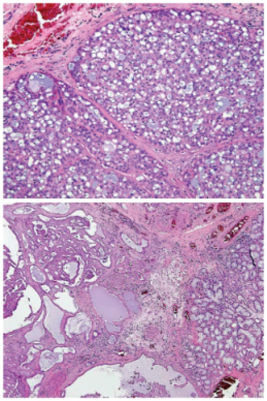 Sekreční karcinom mamárního typu (MASC): typická mikrocystická struktura s uniformními nádorovými buňkami, blandního vzhledu, s pravidelnými vesikulárními jádry, jedním centrálně lokalizovaným zřetelným jadérkem a eosinofilní vakuolizovanou nebo vodojasnou cytoplasmou (A). MASC je nádor strukturálně variabilní, takže tubulární, solidní, makrocystická a kribriformní ložiska v různých proporcích nejsou výjimkou (B) (hematoxylin-eozin).