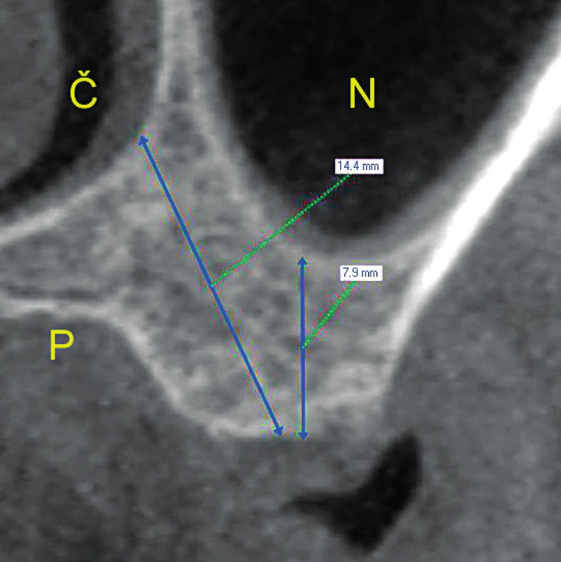 Palatinální sklon apexu umožní zavést delší implantát (CBCT snímek)