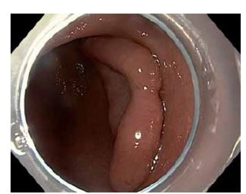 Povrchová neoplastická léze typu 0–IIa+IIc velikosti 66 × 40 mm v antru žaludku.
Fig. 1. Superficial neoplastic lesion, type 0–IIa+IIc, size 66 × 40 mm, location gastric antrum.