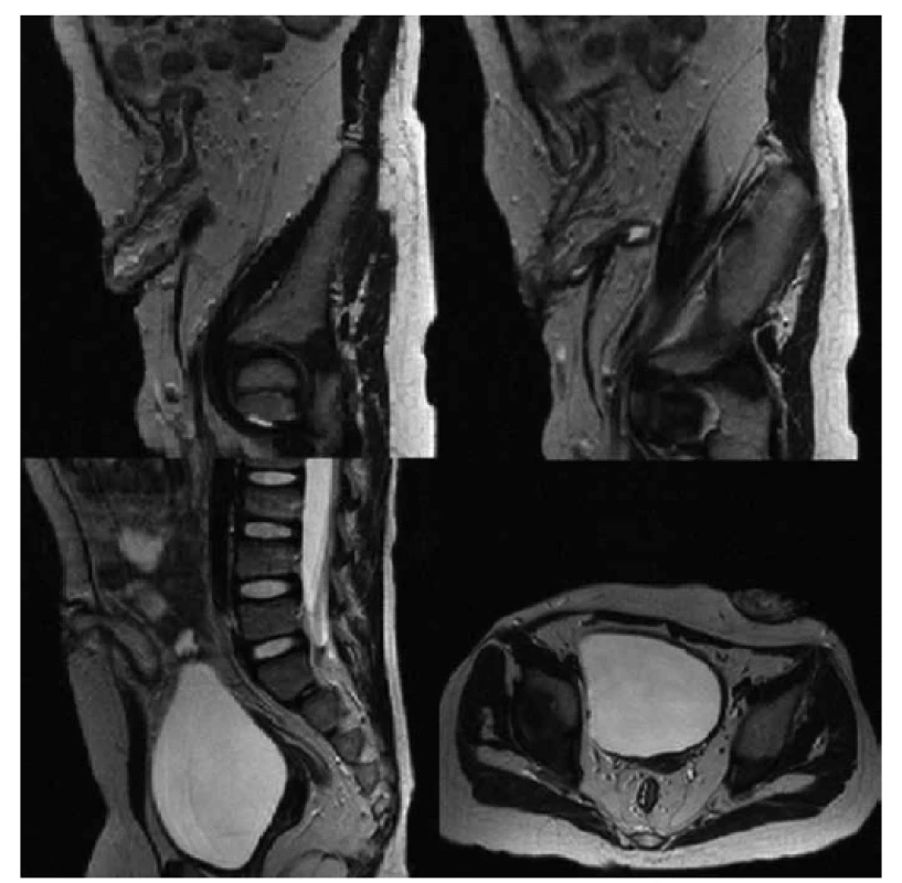 MR vyšetrenie brucha u pacientky s fistulujúcou formou Crohnovej choroby.
Fig. 1. Abdominal MRI scans in patient with fistulating Crohn‘s disease.