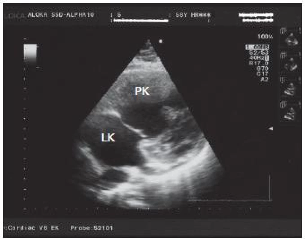 Transtorakálna echokardiografi a z roku 2006, parasternálna projekcia na dlhú os: dilatácia pravej komory (PK), ktorá je väčšia ako ľavá komora (ĽK).