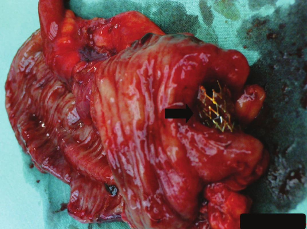 Metalický stent v lumen resekované tenké kličky (černá šipka)
Fig. 2: Metallic stent in the lumen of the resected small bowel ( black arrow)