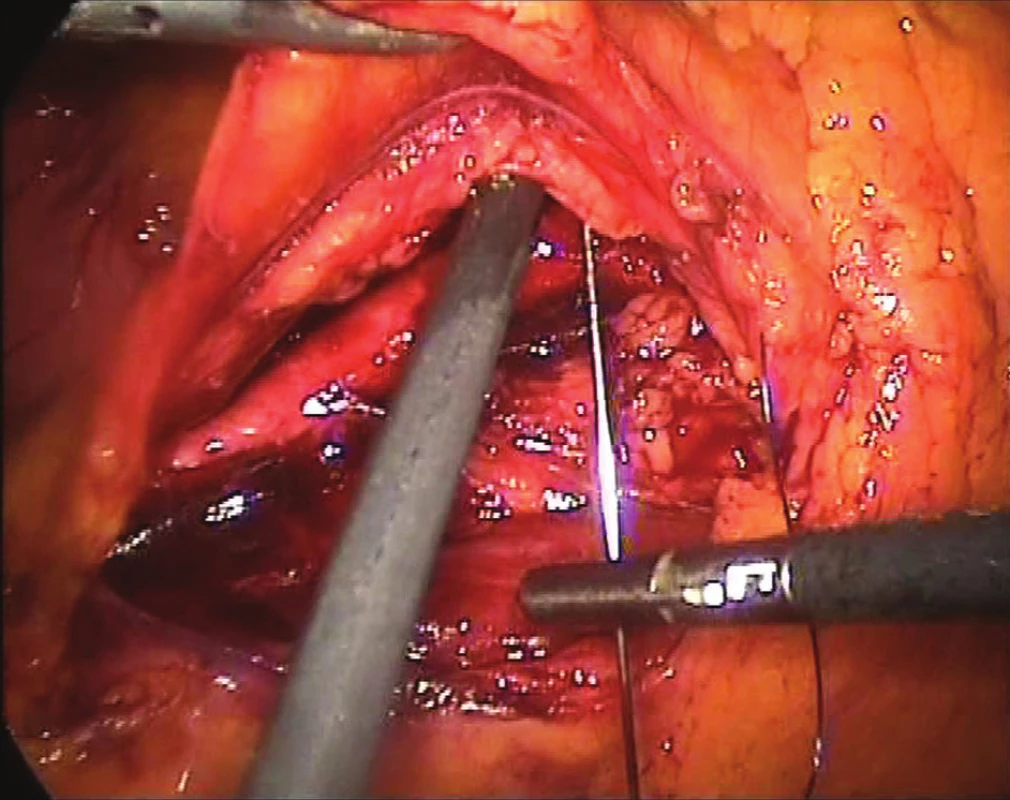 Vyvěšování zadního peritonea