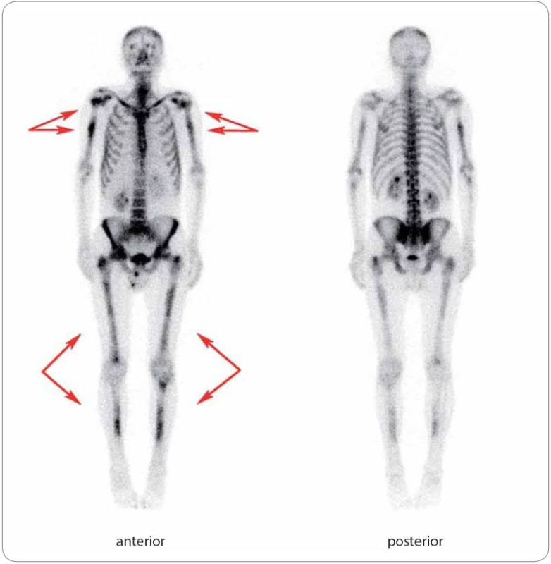 Mnohočetné postižení skeletu u případu 4 na TcS.