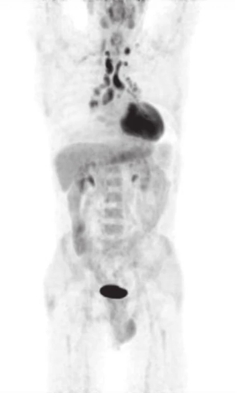 Pacient č.1, X/2011 PET/CT (MIP).