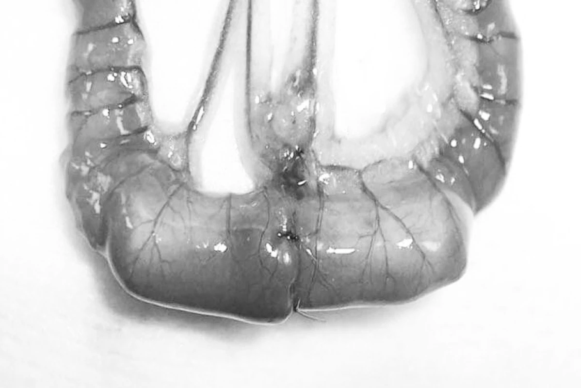 Při aproximační anastomóze je kontinuita a integrita střeva zajištěna 5 seromuskulárními stehy
Fig. 1. In approximative anastomosis, the continuity and integrity of bowel is achieved with 5 seromuscular stitches