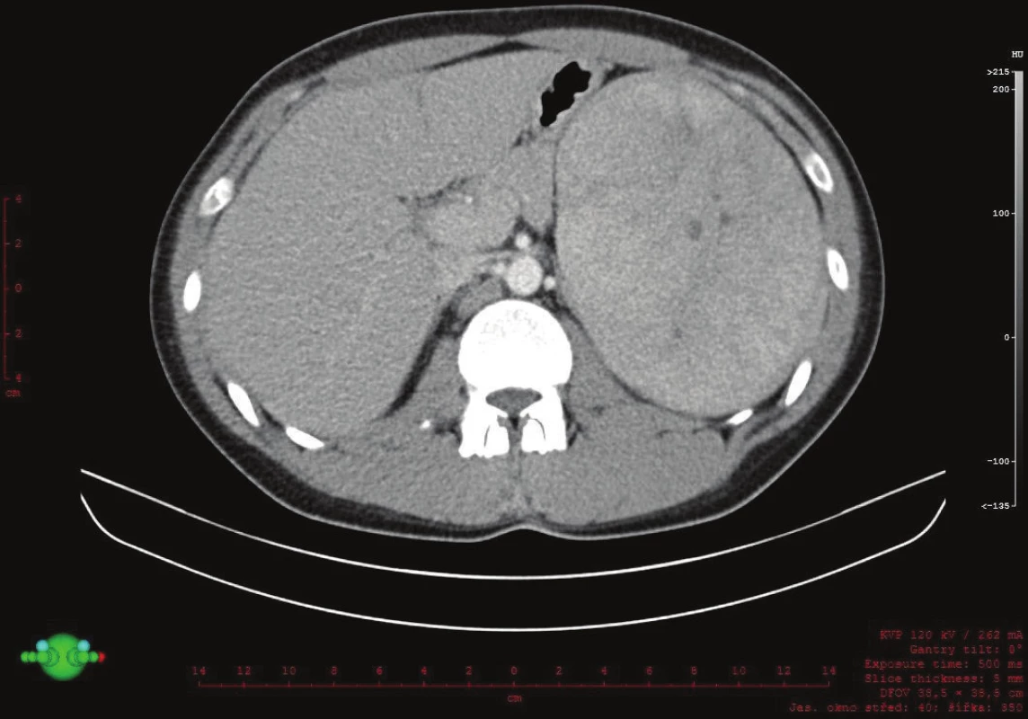 Záchyt expanze v levém podžebří na CT, transverzální řez
Fig. 2: Expansion in the left hypochondrium on a transverse CT scan