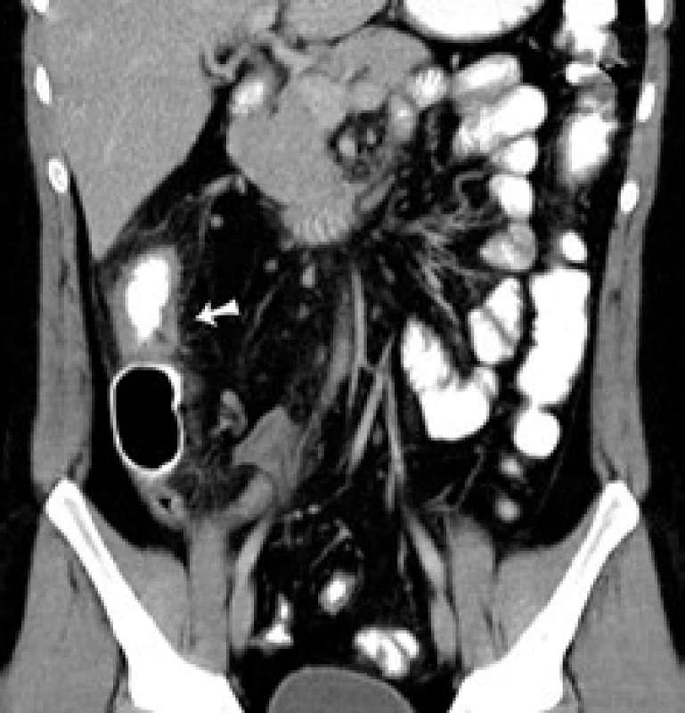 CT koronárny rez: šípka označuje pôvodne suponovanú stenózu ileoascendentnej anastomózy.
Fig. 2. CT of coronary cross-section: arrow indicates originally assumed stenosis of the ileoascendental anastomosis.