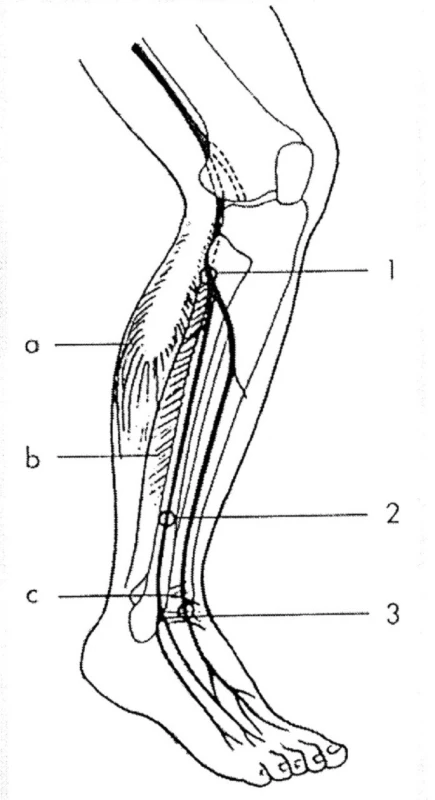 Úžiny a místa komprese n.peroneus
Úžiny:
1 – peroneální tunel (pod vazivovým začátkem m. peroneus longus),
2 – r. superficialis (průstup fascií bérce),
3 – přední tarzální tunel.
Svaly:
a – m. triceps surae,
b – m. peroneus longus,
c – ligamentum 