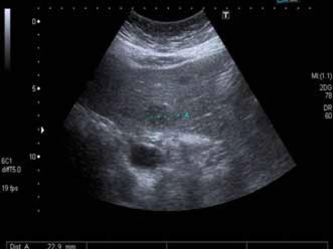 Ložisko lymfomu v játrech. Ultrazvukové vyšetření jater prokazující hypoechogenní ložisko velikosti 22 mm.
Fig. 1. Lymphoma in the liver. Ultrasound showing a hypoechogenic mass of 22 mm in diameter