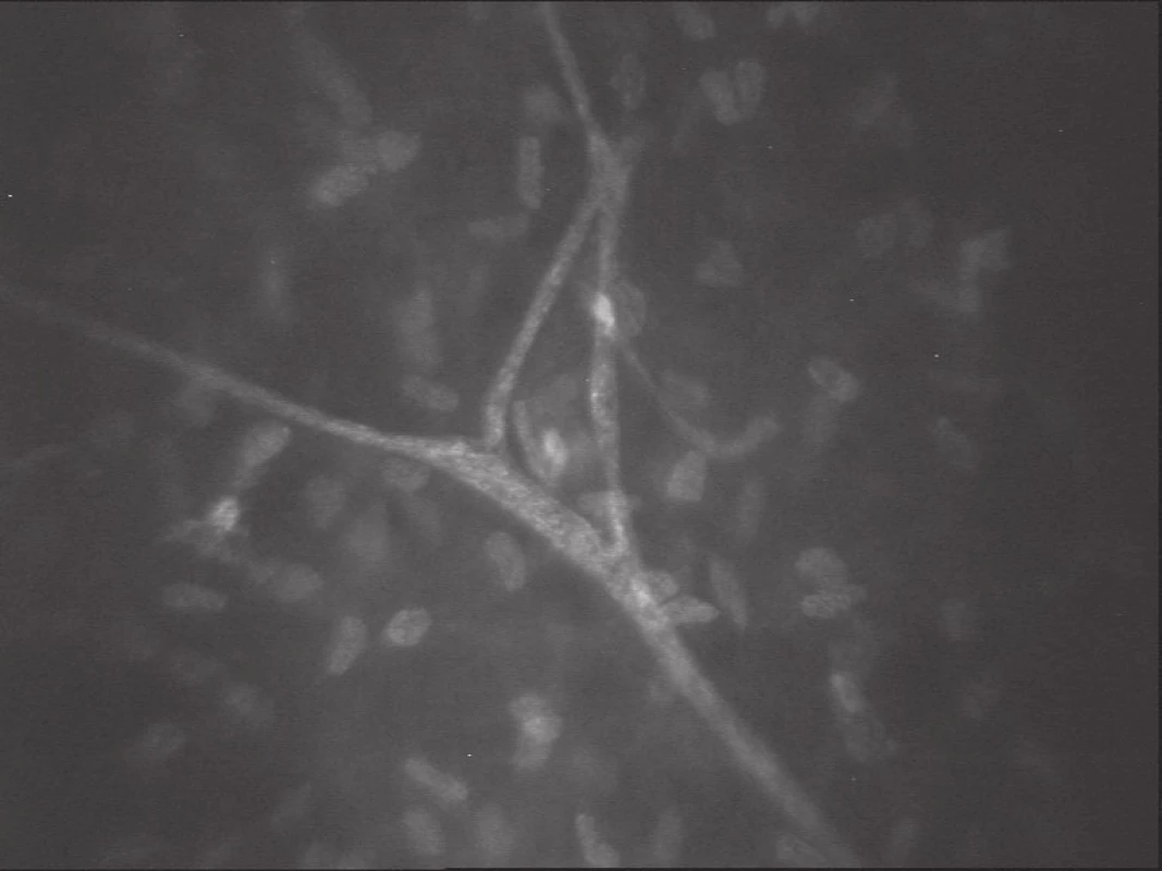 Stroma. Stromální nerv – ypsilon větvení (SSCM; Confoscan 3, NIDEK Technologies)