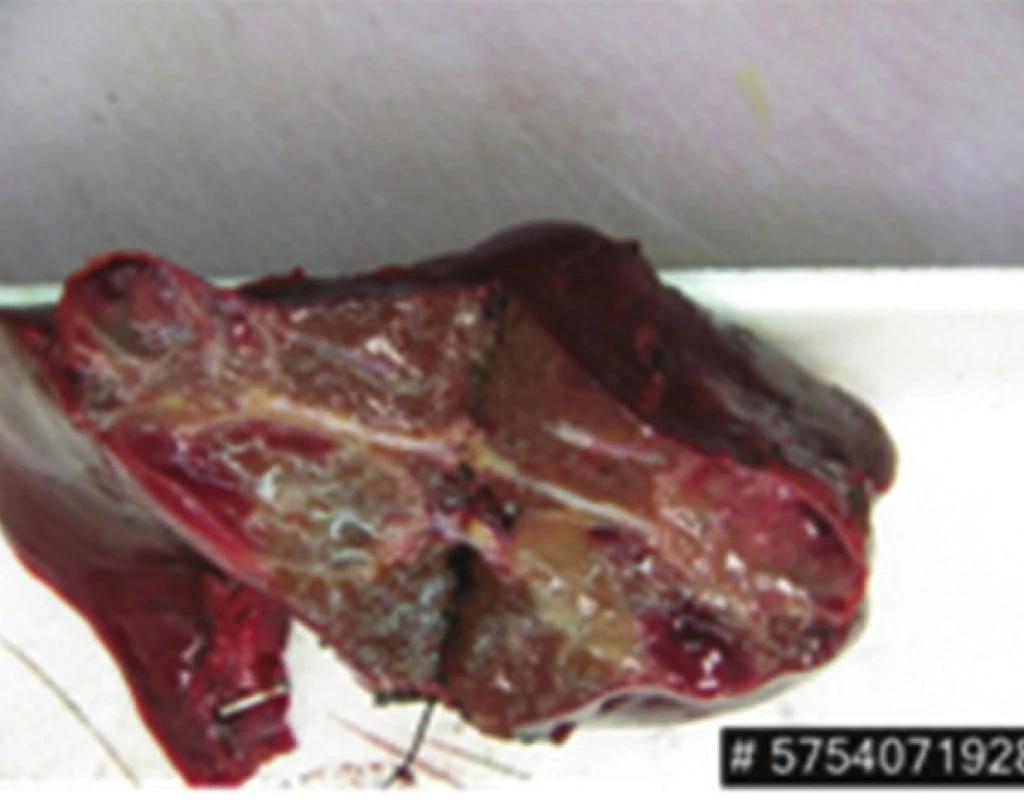 Resekát jater – levostranná hemihepatektomie s dvěma metastázami
Fig. 6: Liver specimen – left hemihepatectomy with two metastases