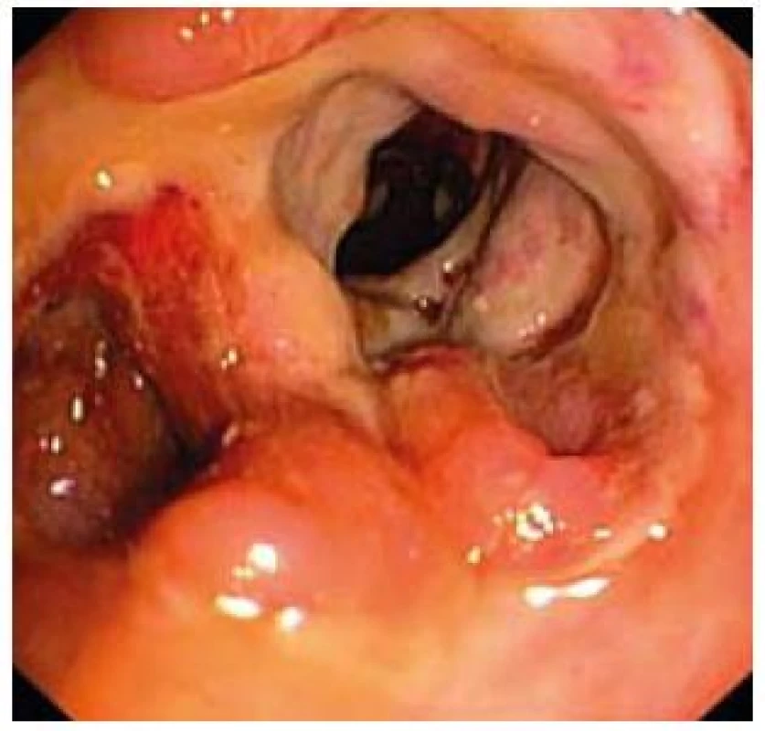 Závažný nález kontinuálnej ulcerácie celej sliznice s hlbokými defektmi sliznice (colon ascendens).
Fig. 5. Serious finding of continuous ulcerations of the entire mucosa with deep defects of mucosa (colon ascendens).
