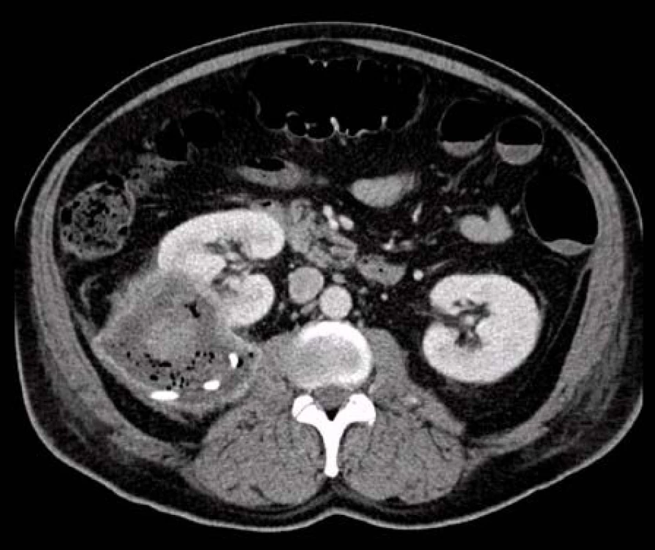 CT: axiální řez cystickým ložiskem pravé ledviny po drenáži
Fig. 3. CT: axial section at the level of the cystic lesion of the right kidney after drainage