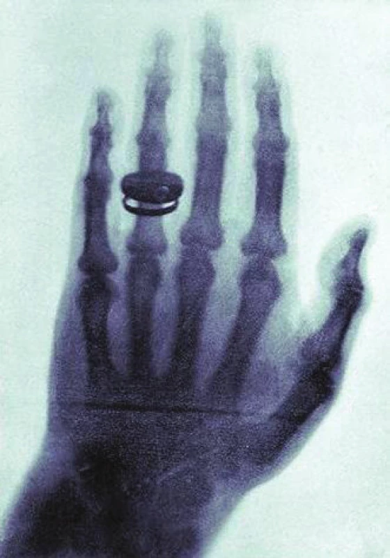 &lt;i&gt;Prosvícená ruka Röntgenovy ženy z ledna roku 1896.&lt;/i&gt;