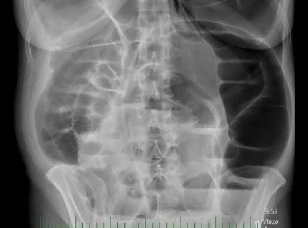 RTG břicha při přijetí.
Fig. 1. Abdominal X-ray on admission.