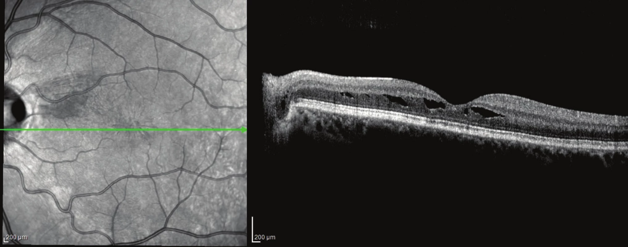 Pacient č. 4
Lineální horizontální transpapilární OCT sken OL po PPV, resorbce subretinální tekutiny a uzavřená komunikace mezi jamkou terče a makulární retinochízou zevní vrstvy sítnice