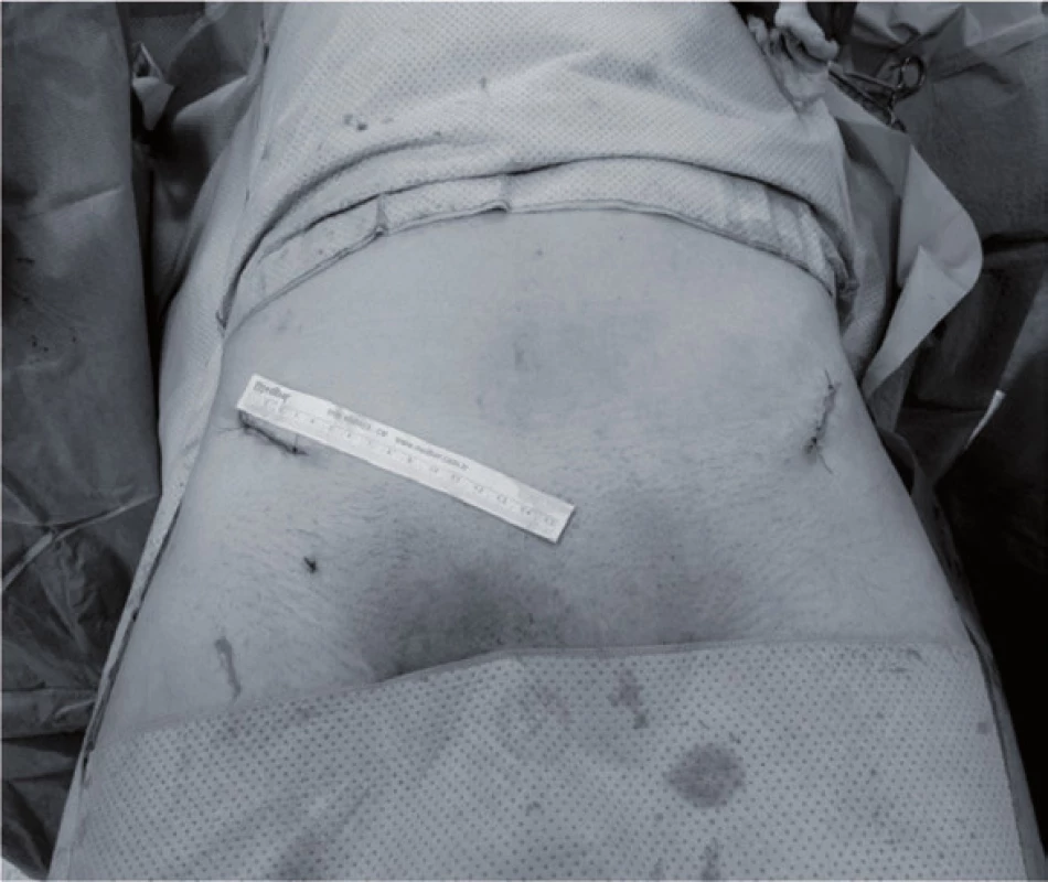 Operační postup: a - zavádění šroubu s polyaxiální hlavici, b - po subkutánní tunelizaci zavedení natvarované titanové tyče, c – přečnívající konce tyče po upnutí do polyaxiálníh hlavic (posléze zakráceny), d – st.p. sutuře ran