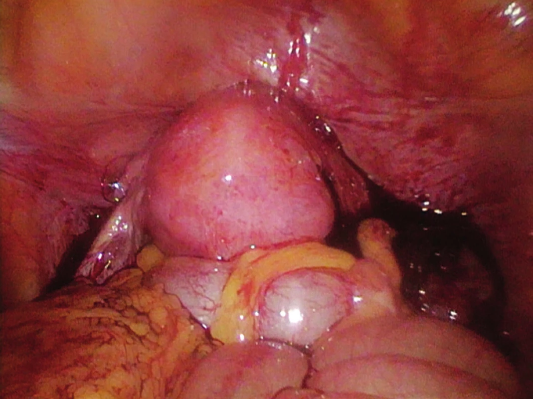 Stav po oboustranné salpingektomii, hemoperitoneum