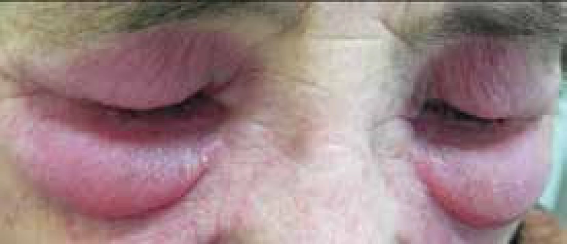 Výrazný edém kolem očí s heliotrop zbarvením u pacientky s dermatomyozitidou