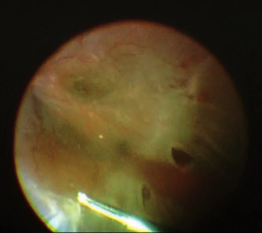 Snímek z peroperačního videa: Totální amoce pravého oka se nepřikládá pod dekalinem, rigidní PVR lze jen s obtížemi odstranit pinzetou, ekvatoriální trhliny jsou prakticky v každém čísle