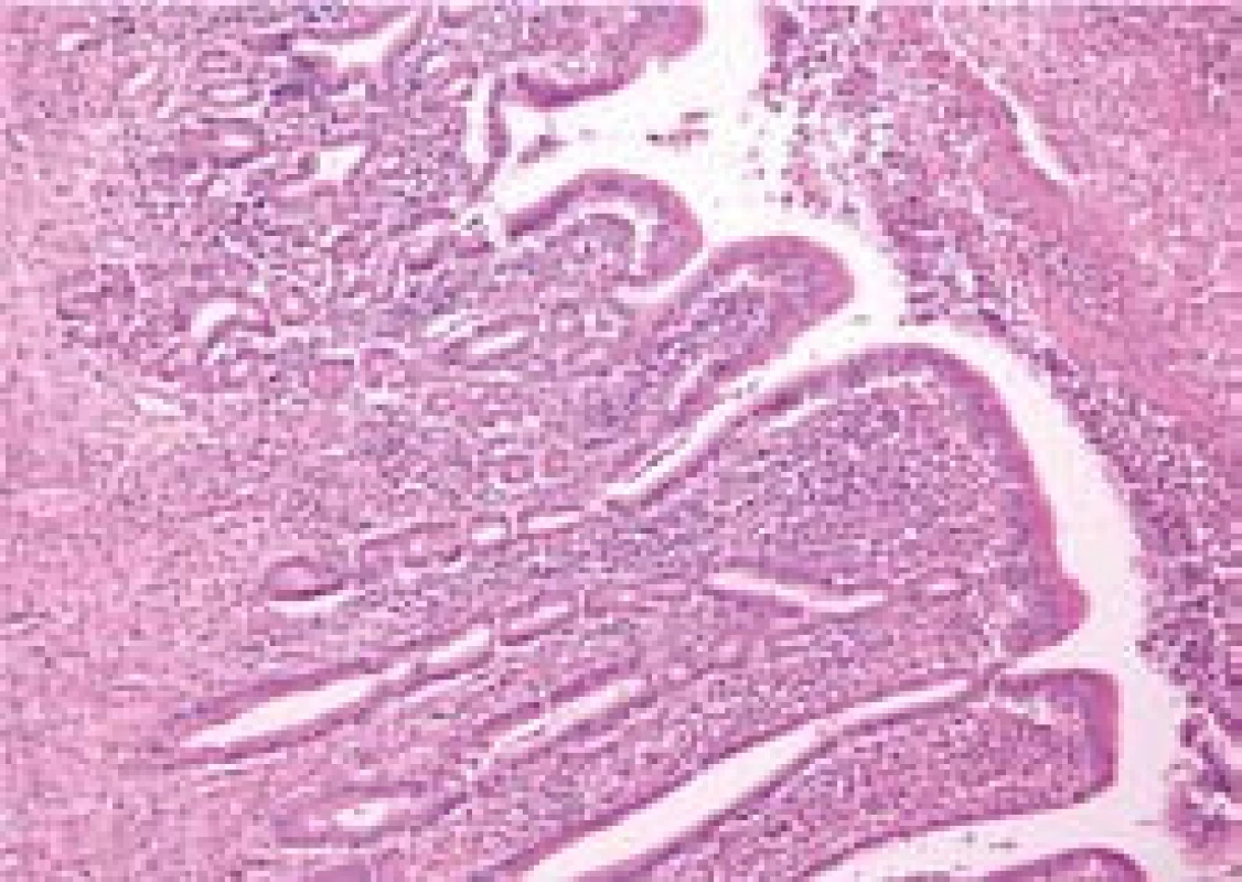 Hlavní pankreatický vývod s lymfoplazmocytární zánětlivou celulizací s příměsí eozinofilů při autoimunní pankreatitidě.
Fig. 4. Main pancreatic duct with lymphoplasmocytic inflammatory cellulization mixed with eosinophils in autoimmune pancreatitis.