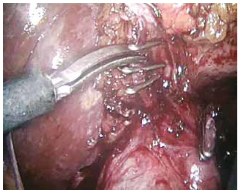 Ligace a střižení a. cystica, ductus cysticus ligován<br>
Fig. 4: Clipping and cutting of the cystic artery, cystic duct
clipped