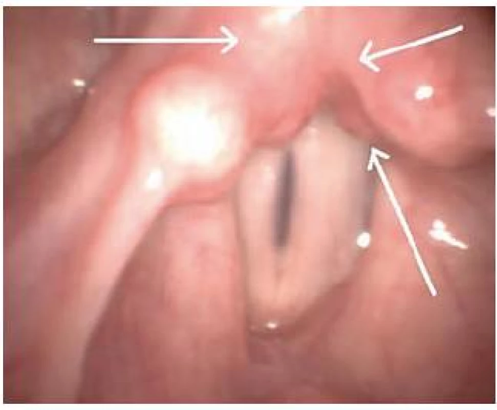Refluxní laryngitida u pacienta s globus faryngeus a zároveň extraezofageálním refluxem. Šipky označují oblast zadní komisury hrtanu a arytenoidních hrbolů, která je prokrvená a oteklá.
Fig. 1. Reflux laryngitis in a patient with globus pharyngeus and concurrently with extra esophageal reflux. The arrows indicate the area of the posterior commissure of the larynx and colliculi of arytenoid cartilages that is supplied with blood and is swollen.