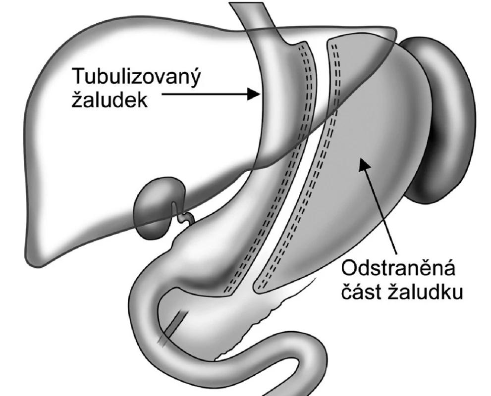 Tubulizace žaludku – sleeve gastrectomy
Fig. 1. Gastric tubulization – sleeve gastrectomy