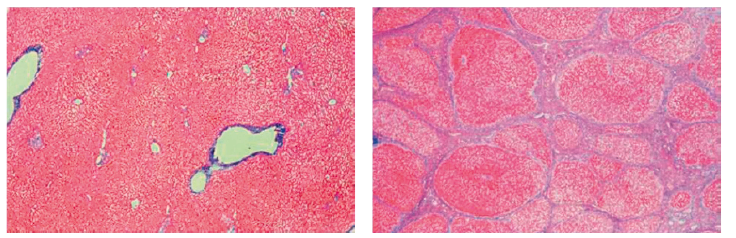 Mikroskopický obraz jater (vlevo normální játra, vpravo cirhotická játra)