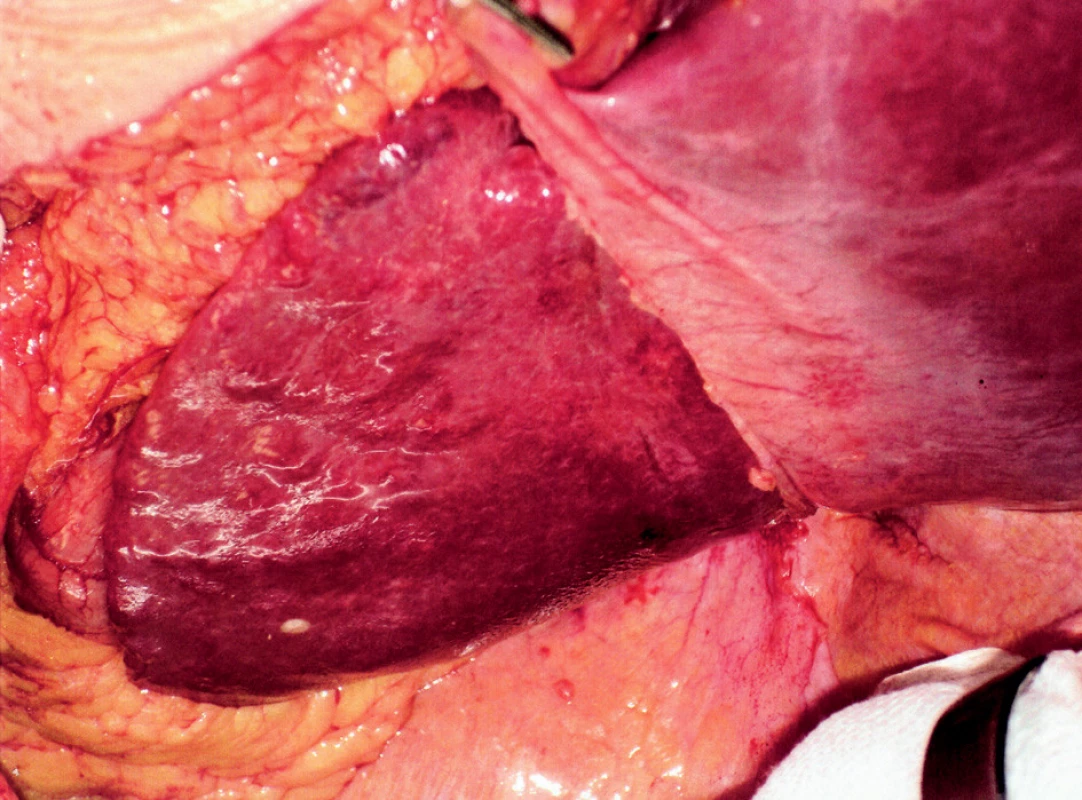 Atrofie levého laloku jater s prosvítajícími konkrementy
Fig. 3. The left liver lobe atrophy, with concrements showing through