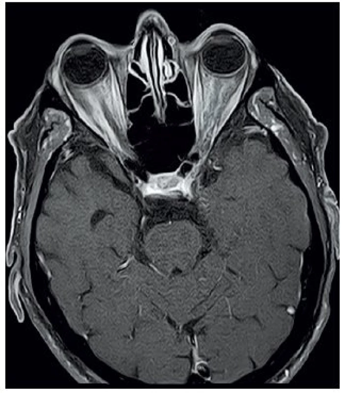 MRI očnic T1 vážený obraz, FSAT, axiální řez, kontrast Dotarem – mírný edém zrakového nervu vpravo s opacifikací