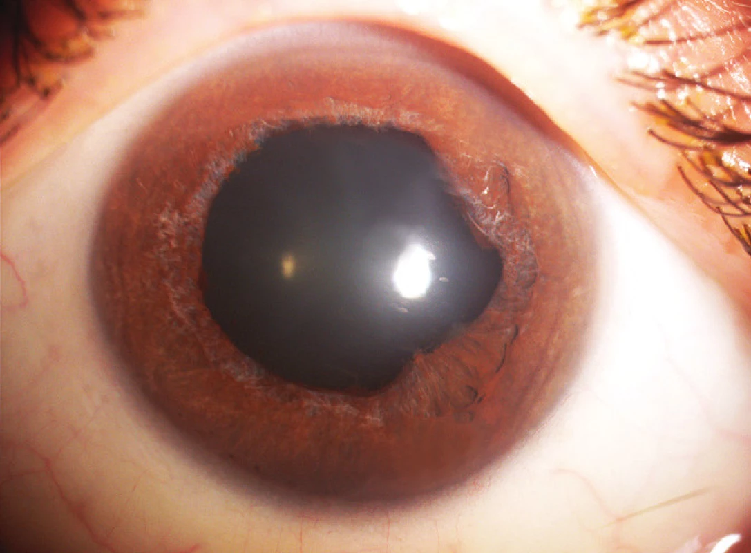 Pacient č. 2 – Přední segment levého oka po jednom roce od začátku zánětu (snímek Oční kliniky VFN)