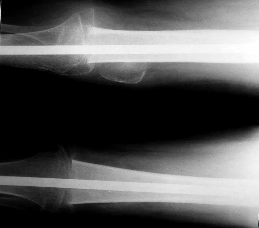 Pacient s osteosarkomem po chirurgickém výkonu: artrodéza kolene se štěpem.