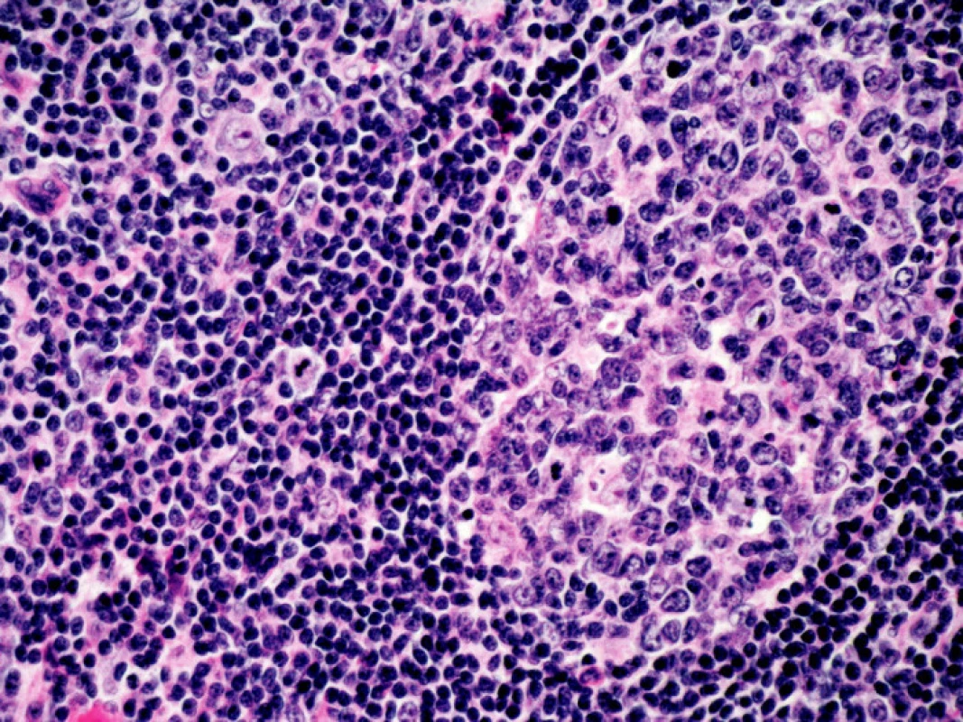 Histologický nález v uzlině. Difuzní velkobuněčný B lymfom, barveno hematoxylin-eosinem, 400x zvětšeno. Kromě velkých atypických buněk typu centroblastů a imunoblastů přítomny velmi četné plazmatické buňky s Dutcherovými tělísky (plazmocytární diferenciace).