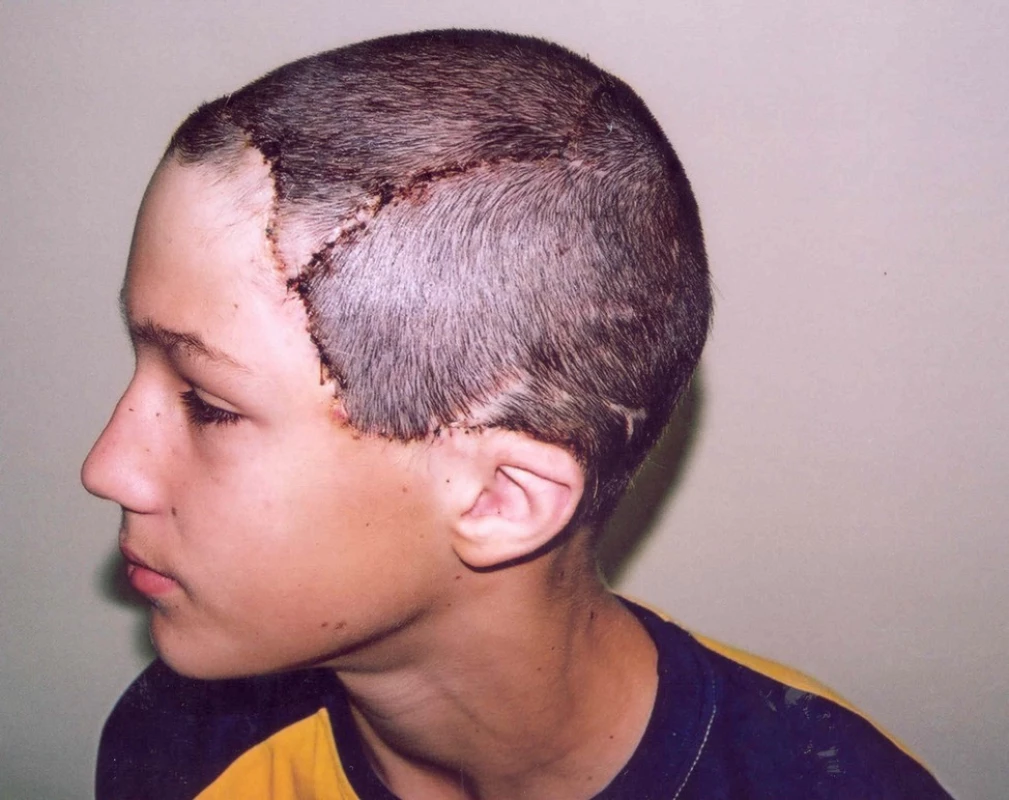 Stav 7 dnů po odstranění expanderů a vykrytí alopetických defektů lalokovými posuny vlasaté části hlavy