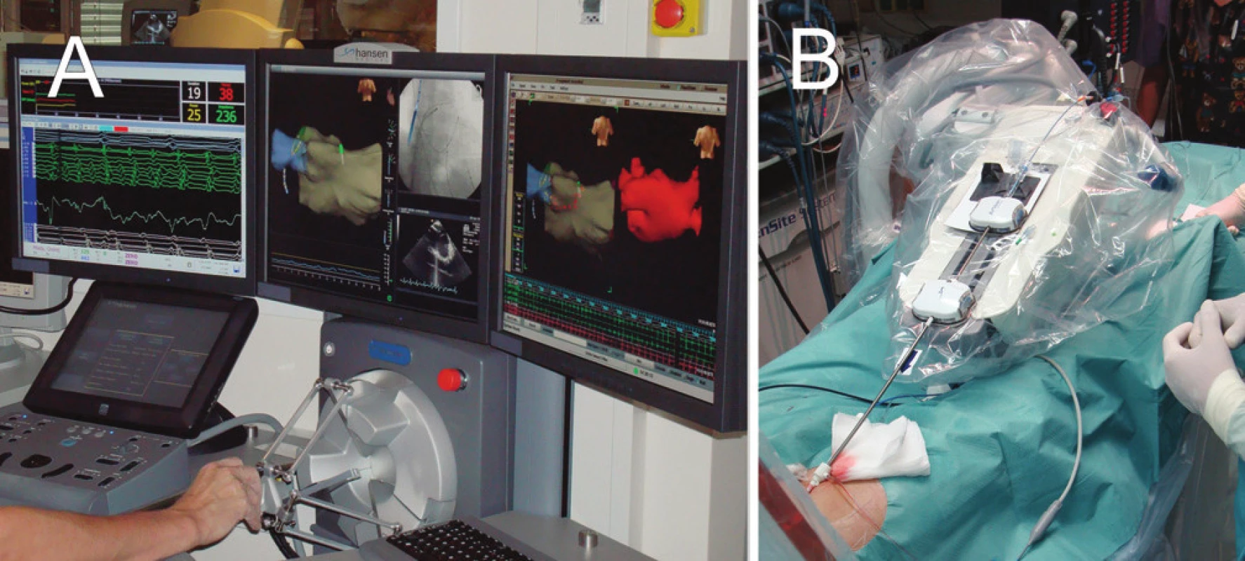 Systém pro robotickou ablaci (Hansen-Medical)
A. Ovládací panel robotického systému, který je umístěn mimo katetrizační sál.
B. Rameno robotického systému, které řídí pomocí zavaděčů pohyb ablačního katétru uvnitř srdce pacienta.