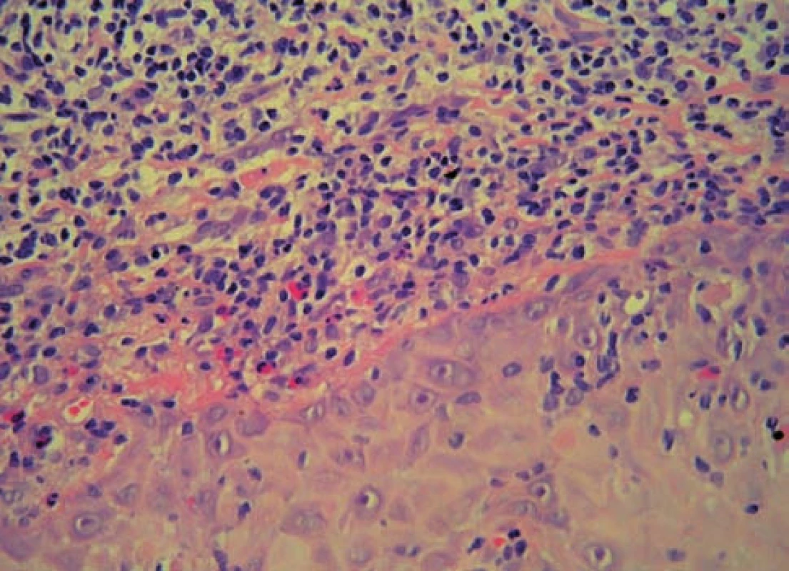 Histologický nález – hustý pruhovitý infiltrát lymfocytů s folikulotropismem (HE, 200x)