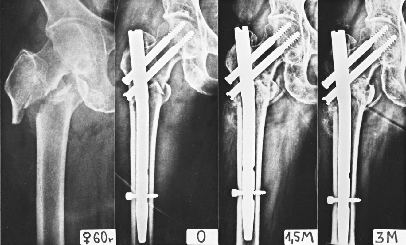 Vliv úhlu hřebu na osteosyntézu intertrochanterické zlomeniny: a – intertrochanterická třífragmentová zlomenina s krátkou laterální kortikalis proximálního fragmentu; b – osteosyntéza provedena PFN 135°, distální skluzný šroub prochází lomnou linií a brání úplné kompresi úlomků v ose dříku hřebu, a to navzdory distálnímu zajištění; c – 6 týdnů po operaci je postavení zajišťovacího šroubu v dynamickém otvoru stejné; d – 3 měsíce po operaci je zlomenina téměř zhojena, pokud by však byl odlomen malý trochanter s přilehlou kortikalis, hrozilo by zlomení hřebu, proto je lépe použít v těchto případech hřeb s úhlem 130°, kdy skluzné šrouby procházejí laterální kortikalis proximálněji. 
Fig. 12: The relation of the nail angle on internal fixation of an intertrochanteric fracture: a – an intertrochanteric three-fragment fracture with a short lateral cortex of the proximal fragment; b – internal fixation by PFN 135°, the distal lag screw passes through the fracture line and prevents full compression of the fragments along the axis of the nail stem, despite distal locking; c – 6 weeks after operation, the position of the locking screw in the dynamic hole is the same; d – 3 months after operation, the fracture has almost healed, however, where the lesser trochanter is separated together with the adjacent cortex, there would be a danger of breaking of the nail; therefore it is better to use a 130° nail in these cases, when lag screws pass through the lateral cortex more proximally.