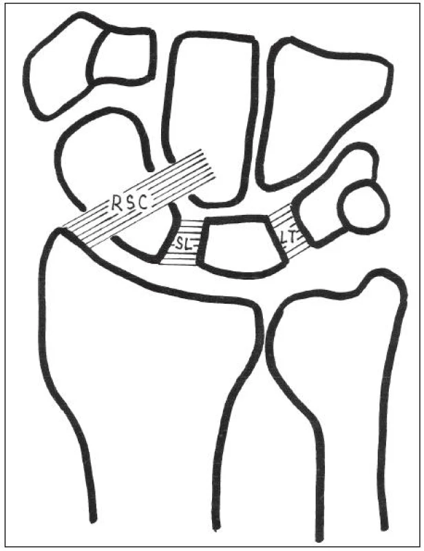 Některé funkčně významné vazy zápěstí (podhled zezadu): RSC – radioskafokapitátní vaz, SL – skafolunátní vaz, LT – lunotriquetrální vaz.